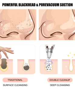 Alternative view of New electric blackhead removal and pore cleaning for blackheads