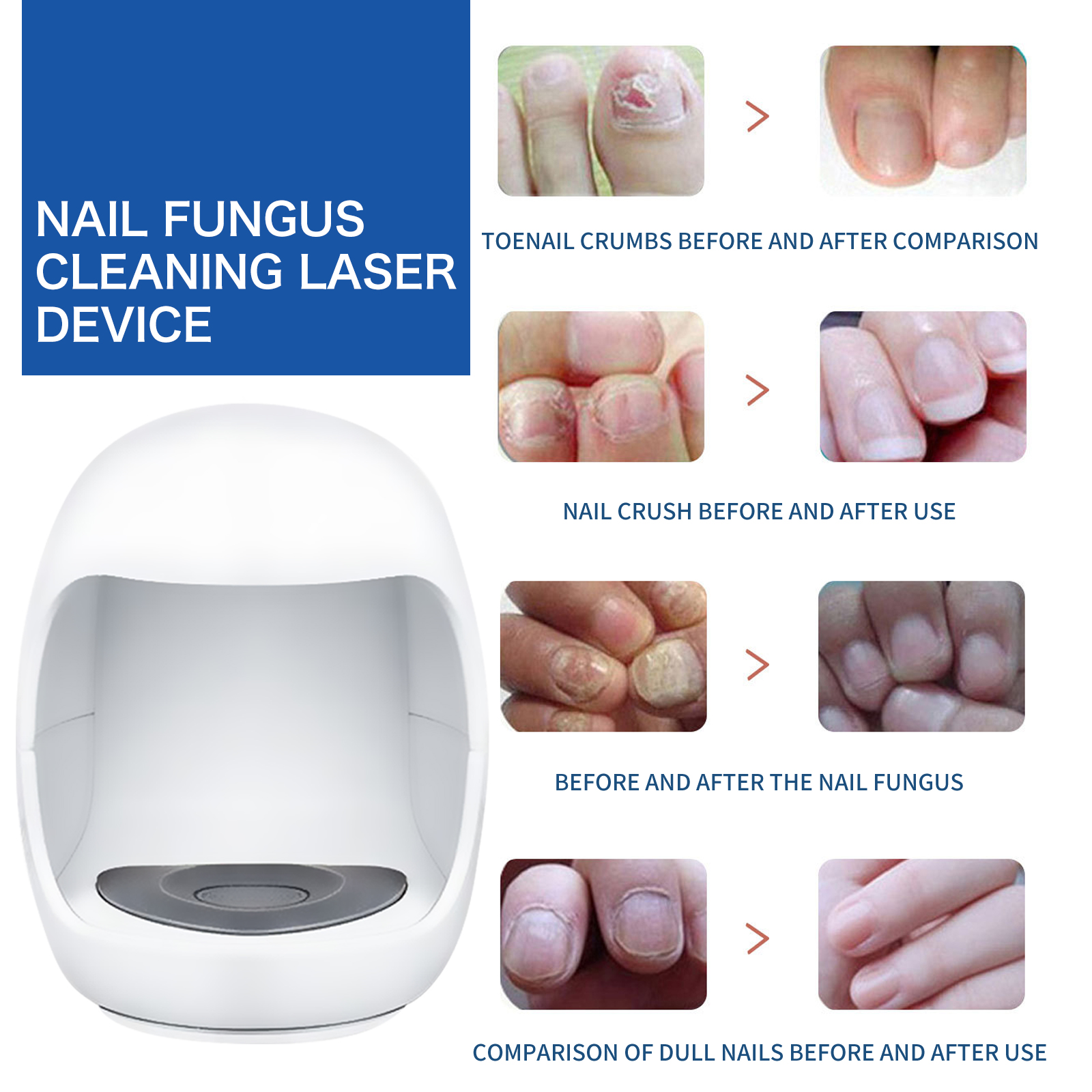 South Moon Nail Care Phototherapy Device, Repair Hands And Feet Gray Nails Yellow Ingrown Nail Soft Nail Care - Image 4